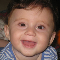 סוגי פזילה - תינוקת עם פזילה מולדת אחרי ניתוח