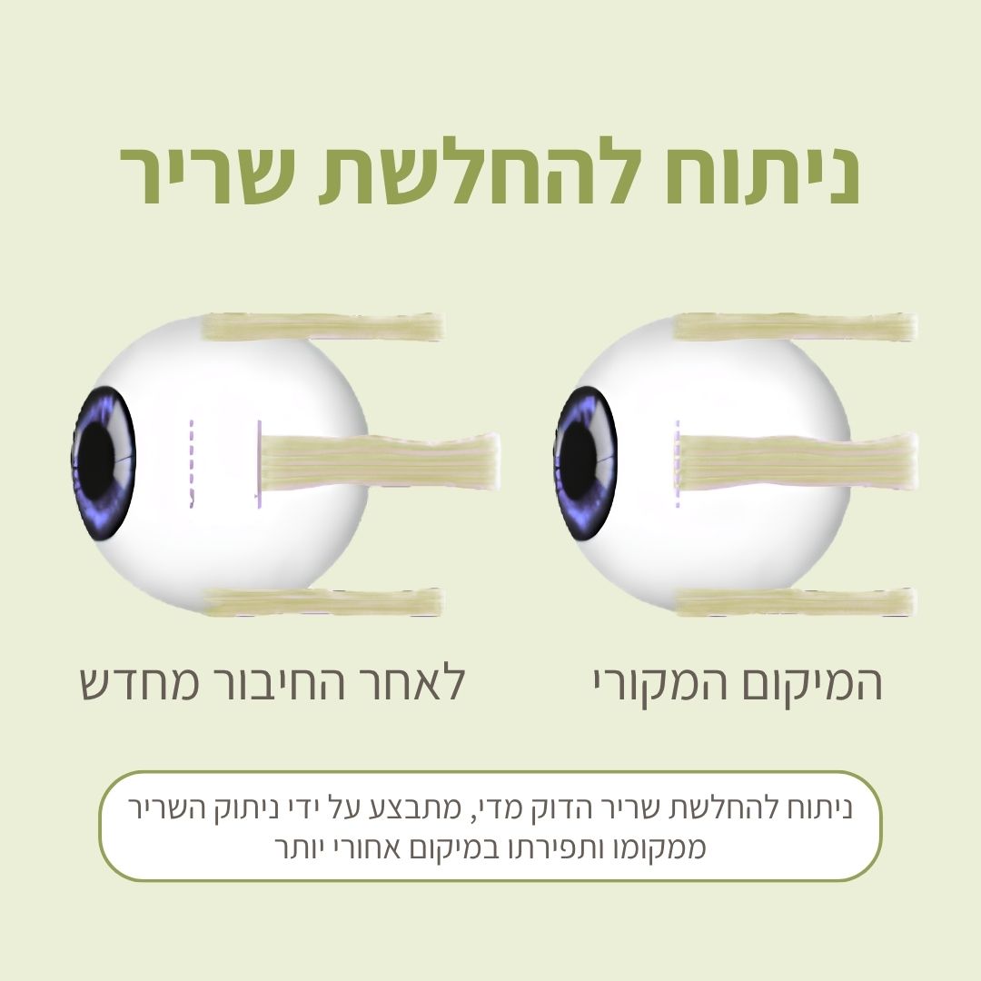 ניתוח להחלשת שריר