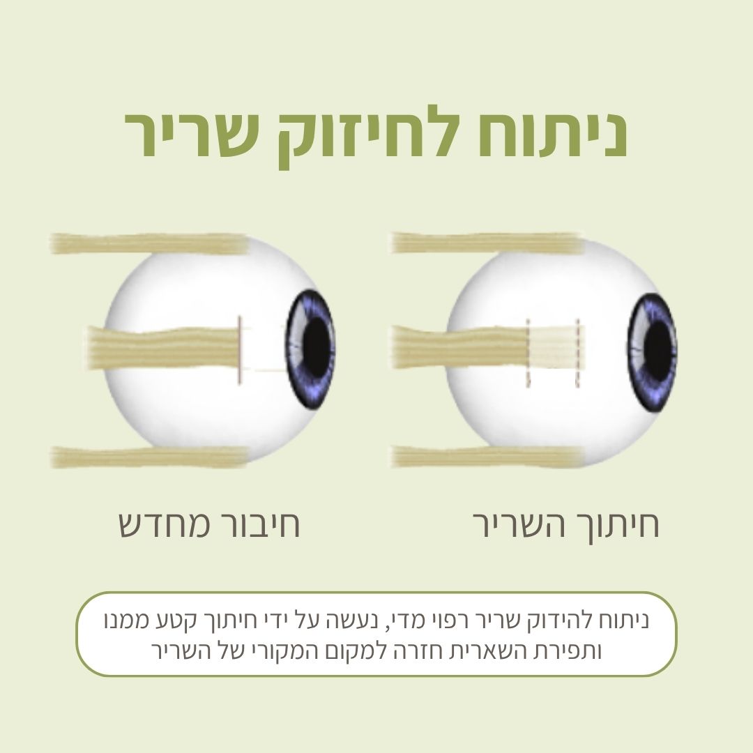 ניתוח לחיזוק שריר