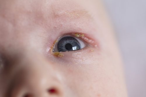 תינוק עם דלקת כתוצאה מחסימת דרכי הדמעות