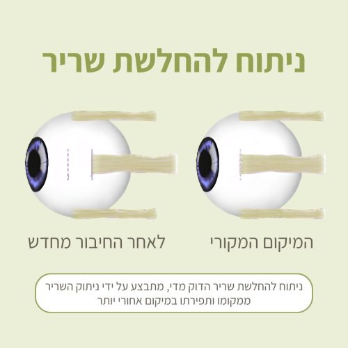 ניתוח להחלשת שריר
