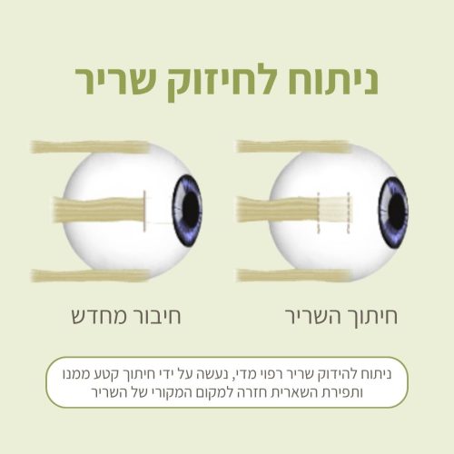 ניתוח לחיזוק שריר